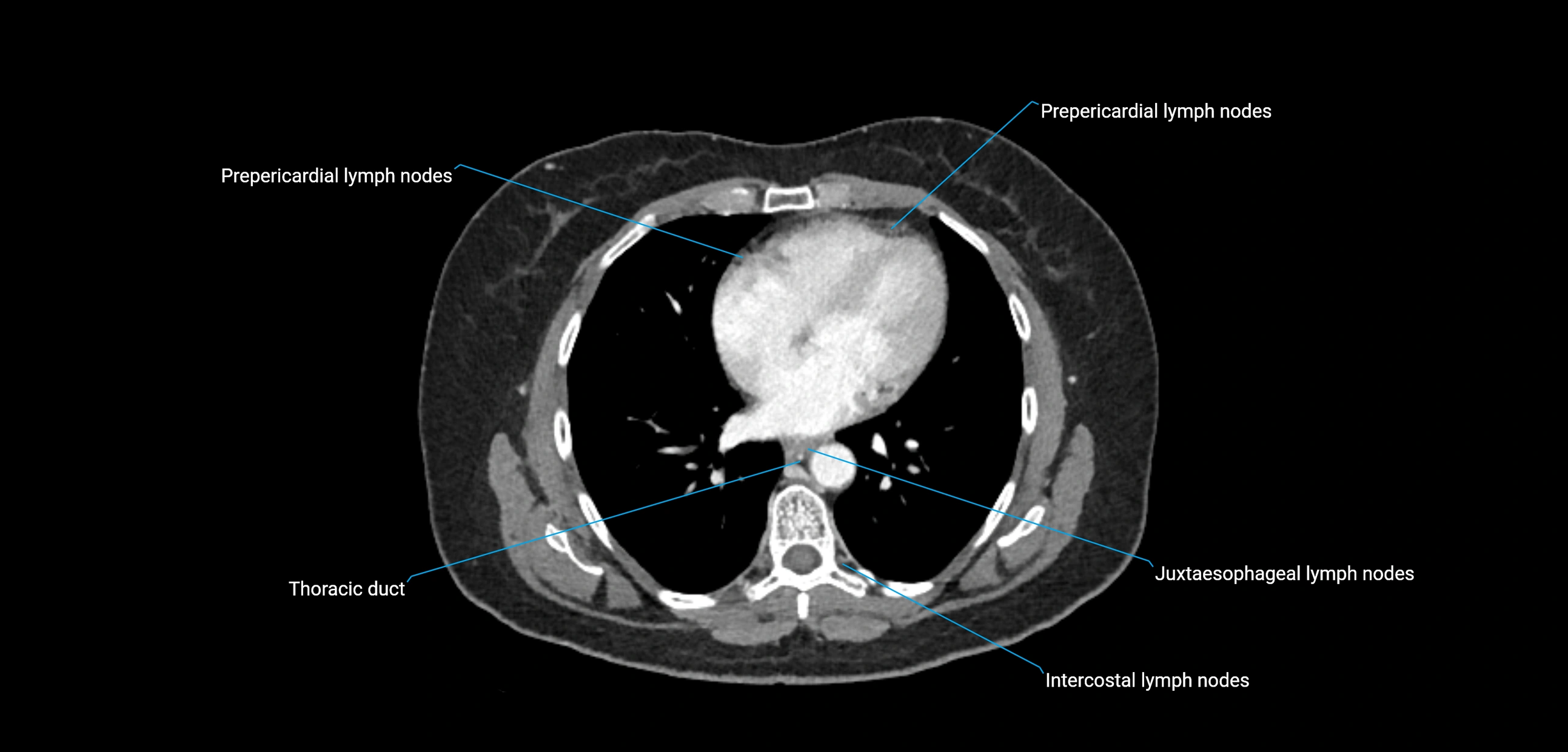 CT ct abdominal lymph nodes  axial cross sectional anatomy  enchanced radiology image -img-00002-00036.webp